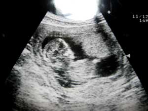 妊娠13週目 お腹の赤ちゃんのエコー画像 妊娠ライフ お腹の赤ちゃん成長記